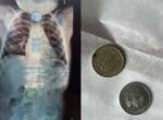Родители не уследили. Хирурги из Бухары спасли жизнь двухлетнего ребенка, проглотившего монеты